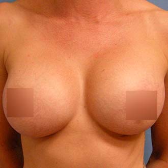 Female breasts, after Breast Augmentation treatment, front view, patient 1