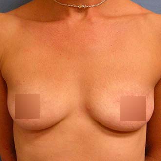 Female breasts, before Breast Augmentation treatment, front view, patient 1
