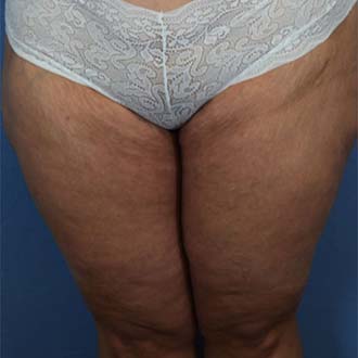 Female body, after Thigh Lift treatment, front view