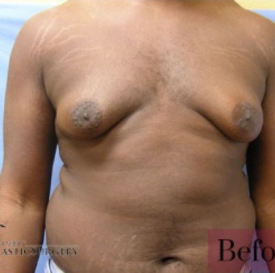 Male body, before Male Breast Reduction treatment, front view