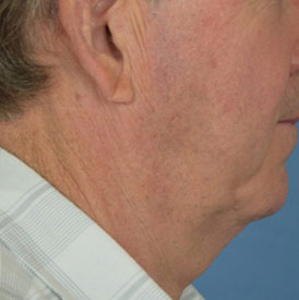 Male body, before necklift treatment, side view
