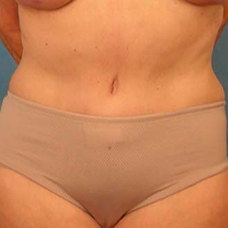 Minimize Tummy Tuck Scars after 5 years Hill Country Plastic Surgeons