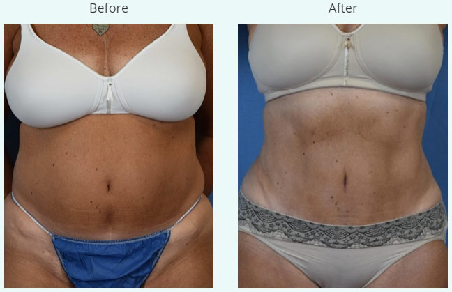 What Liposuction Can & Can't Do For Your Body - Ambay Plastic Surgery